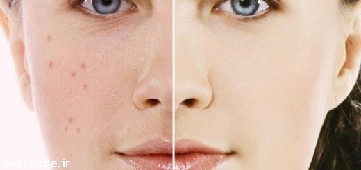 از بین بردن جای جوش با جوش شیرین