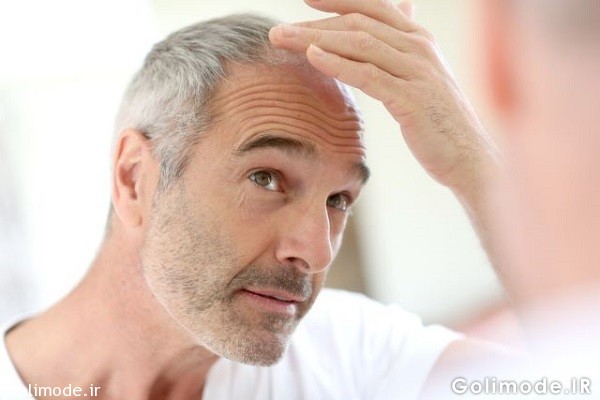 حقایقی جالب توجه درباره طاسی مردانه