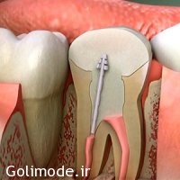 هرآنچه باید درباره عصب‌کشی دندان‌ها بدانید
