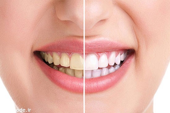 چهار روش طبیعی برای سفید کردن دندان ها سفید کننده دندان